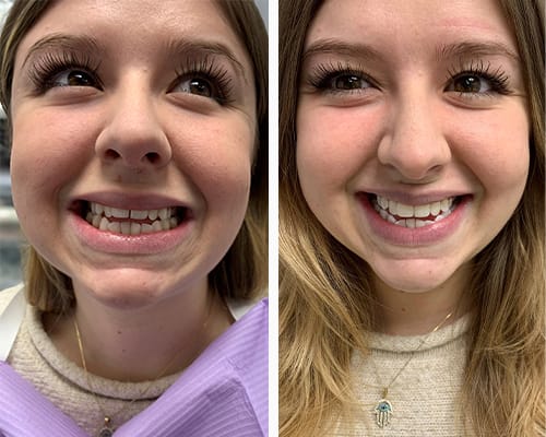 How Much Do Braces Cost in Ottawa?