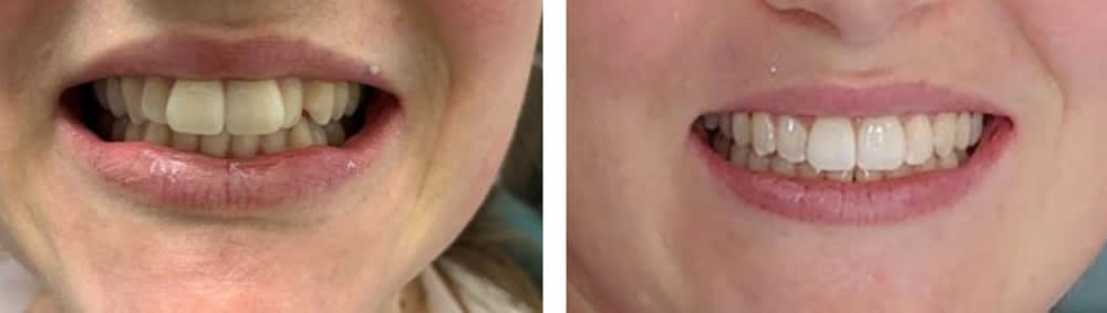 Before & After Invisalign | Ottawa Downtown Dentist