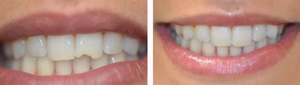Before & After Dental Bonding | Ottawa Downtown Dentist